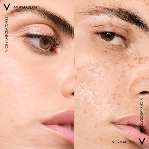 Раствор Vichy Мицелярный Нормадерм для очищения проблемной чувствительной кожи 200 мл